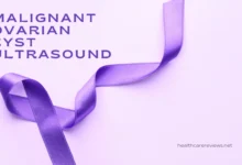 malignant ovarian cyst ultrasound